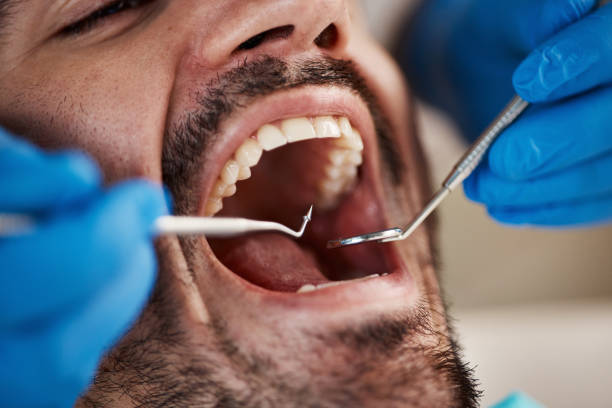 Best Emergency Tooth Extraction in Middleton, WI